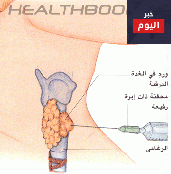 الغدة الدرقية