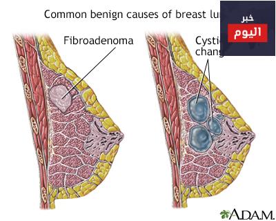 كتل الثدي - Breast Lump