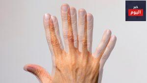 ازدواجية الرؤية - Diplopia