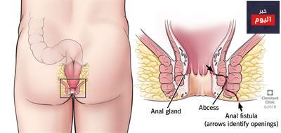 آلام الشرج - Anal Pain