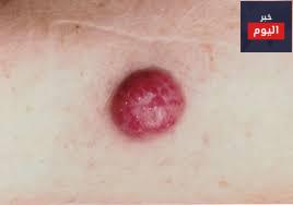 سرطان الخلايا الصبغية - Melanoma