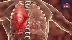 ذات الرئة المكتسبة من المجتمع - Pneumonia