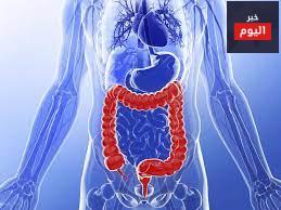 التهاب القولون التقرحي - Ulcerative colitis