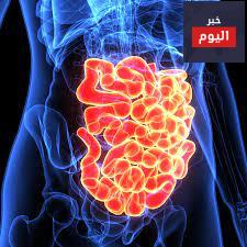 سرطان الأمعاء - Bowel Cancer