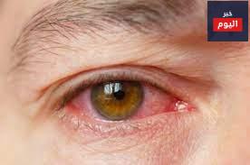 الكلاكوما - Glaucoma