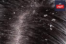 قشرة الرأس - Dandruff