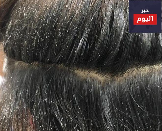 كيفية علاج الصئبان - How to treat nits
