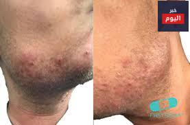 الشعر الناشب - Ingrown Hairs
