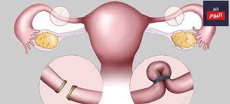 تعقيم الإناث - Female sterilisation