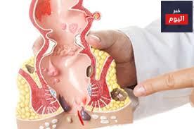 الناسور الشرجي - Anal fistula