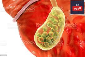 الحصى الصفراوية - Gallstones