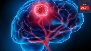 الورم الدماغي الحميد ,غير سرطاني - Brain tumour, benign (non-cancerous)