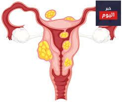 الأورام الليفية - Fibroids