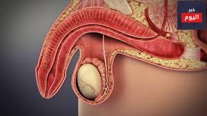 الخلل في وظيفة الإنتصاب - Erectile Dysfunction
