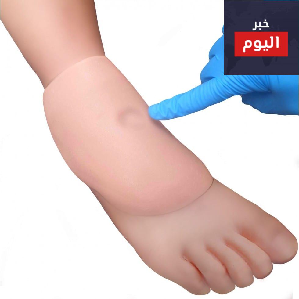 الوذمة - Oedema