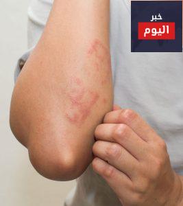 الطفح الجلدي في الحمل