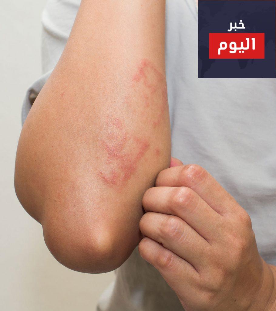 الطفح الجلدي في الحمل