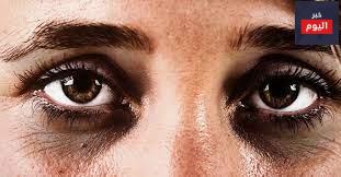 8 أسباب للهالات السوداء ، وطرق علاجها