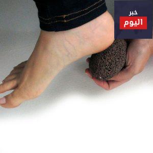 التقشير