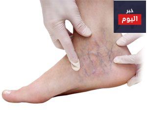 الدوالى وكيفية علاجها