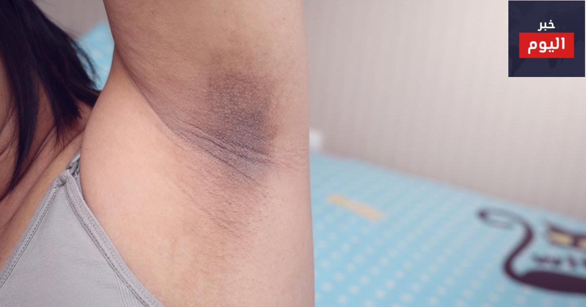 خلطات طبيعية للتخلص من إسوداد الإبط