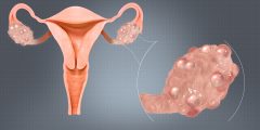تكيس المبايض: الأسباب، التشخيص والعلاج