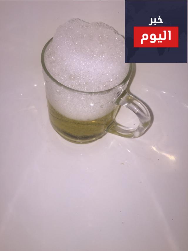 تحليل الحمل بالكلور