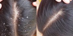 طرق علاج قشرة الشعر