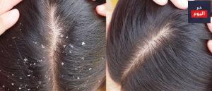 طرق علاج قشرة الشعر