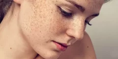 طرق إزالة النمش من الوجه