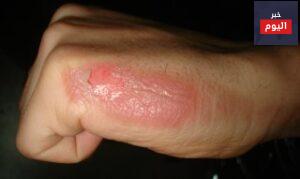 طرق علاج الحروق