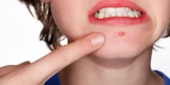 طرق التخلص من حب الشباب بسرعة