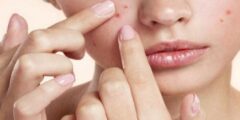 طريقة للتخلص من حب الشباب وآثاره
