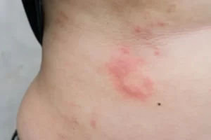 طفحُ الحمل: هل هو مرضٌ جلديٌّ خطير؟