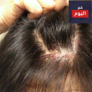 علاج حكة الراس
