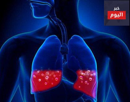 علاج ماء الرئة