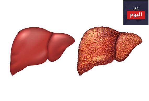 تليف الكبد اسبابه ومضاعفاته – Cirrhosis, treatment and complications