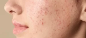 كيف أمنع ظهور الحبوب و البثور بعد إزالة الشعر