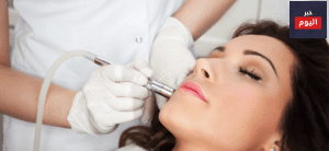 Pros and Cons of Laser Treatment for Acne 1