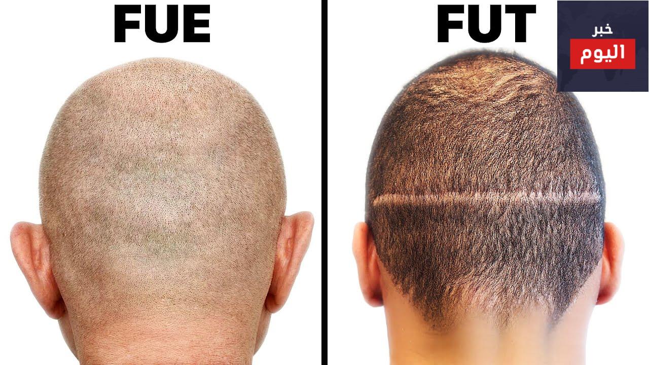 مقارنة بين طرق زراعة الشعر FUT وFUE.