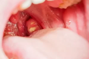 طريقة نزع حصى اللوزتين