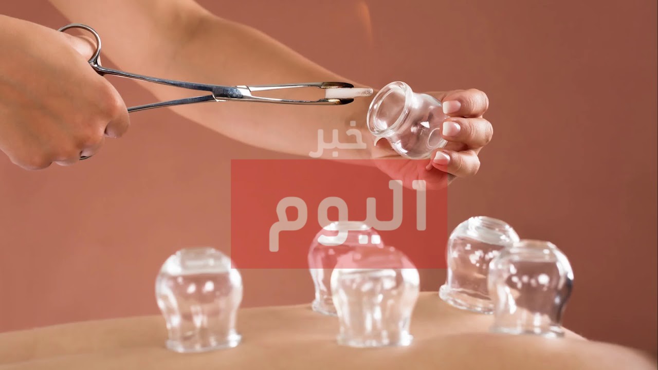 طريقة الحجامة الصحيحة
