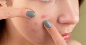 طريقة استخدام فيوسيباكت ب لحب الشباب