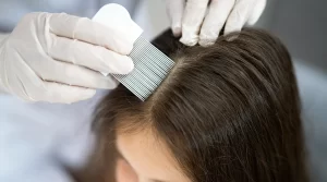 طريقة القضاء على القمل