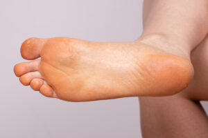 Yellowish Foot Sole Causes and Treatments