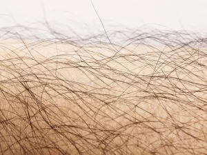 أسباب ظهور الشعر الزائد بالجسم بكثافة وكيفية علاجه
